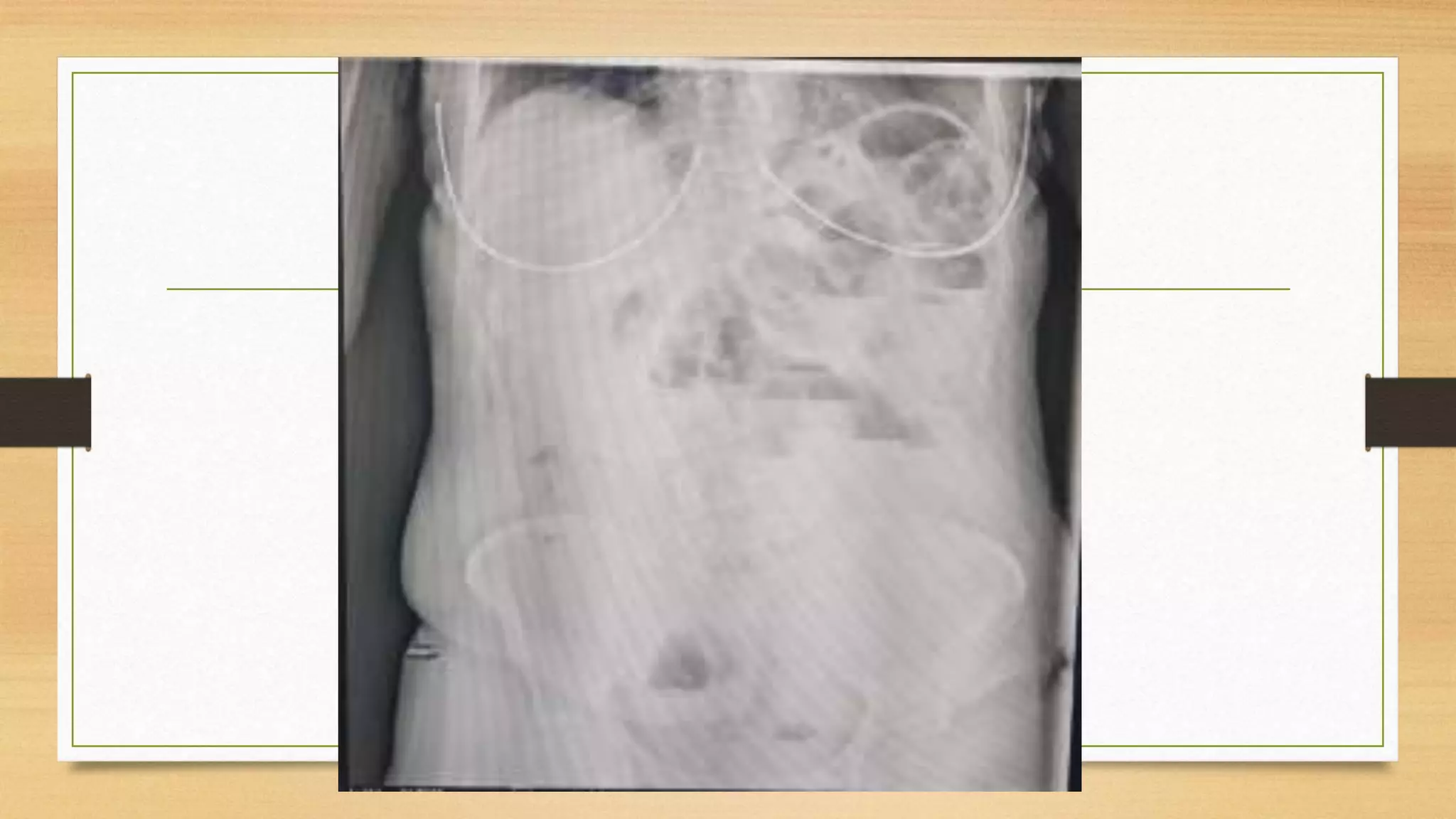 Strangulated Femoral Hernia PPTX