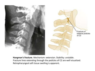 Hangman's fracture. Mechanism: extension. Stability: unstable. Fracture lines extending through the pedicles of C2 are well visualized. Retropharyngeal soft tissue swelling is apparent.