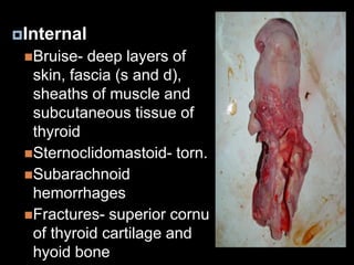 Internal
Bruise- deep layers of
skin, fascia (s and d),
sheaths of muscle and
subcutaneous tissue of
thyroid
Sternoclidomastoid- torn.
Subarachnoid
hemorrhages
Fractures- superior cornu
of thyroid cartilage and
hyoid bone
 