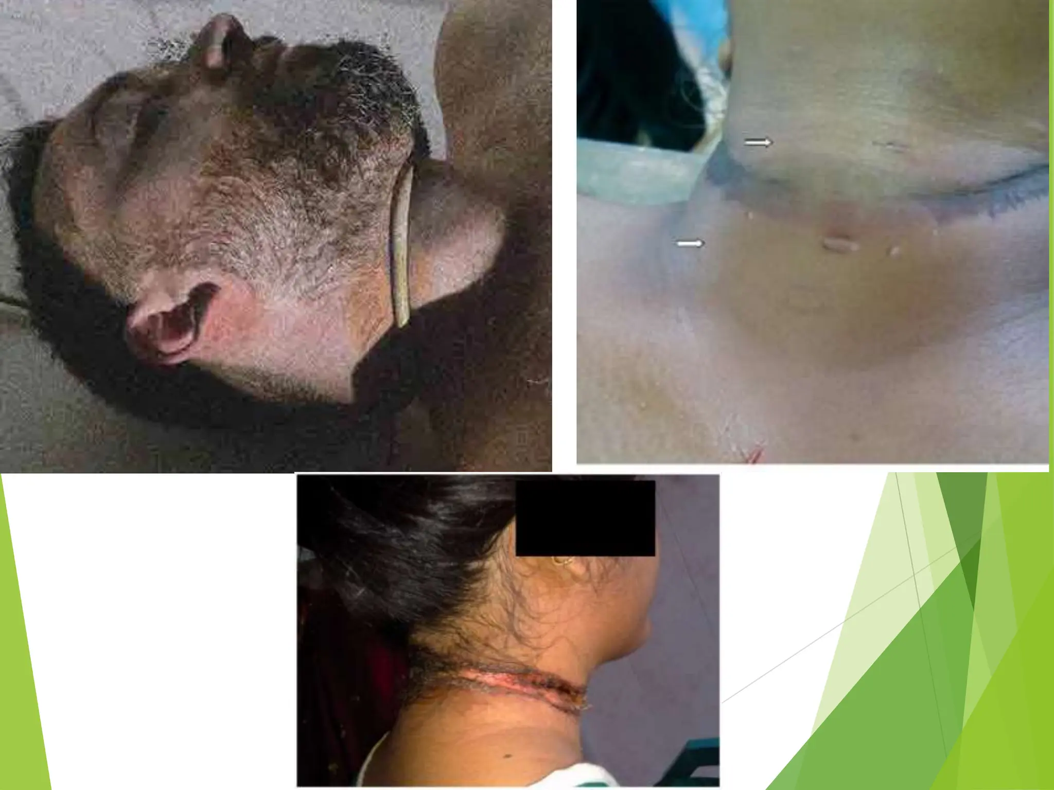 strangulation forensic medicine important.pptx