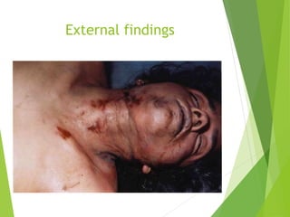 External findings
 