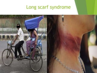 Long scarf syndrome
 