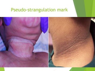 Pseudo-strangulation mark
 