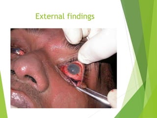 External findings
 