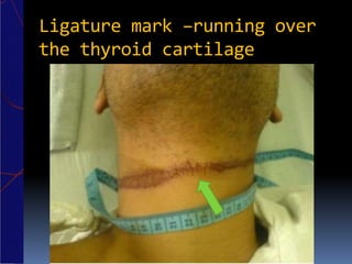 Ligature mark –running over
the thyroid cartilage
 