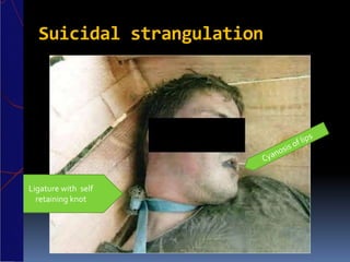 Suicidal strangulation
Ligature with self
retaining knot
 