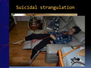 Suicidal strangulation
 