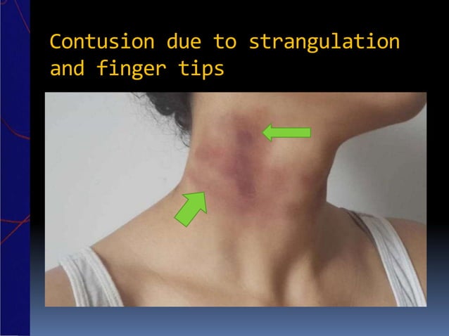 Strangulation a forensic view | PPTX | Death, Injury, or Military ...