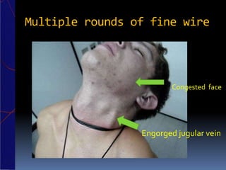 Multiple rounds of fine wire
Engorged jugular vein
Congested face
 