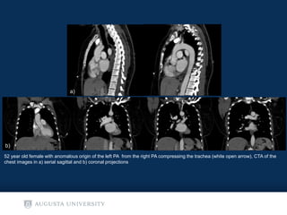 Aortic Arches A REVIEW E POSTER | PPTX
