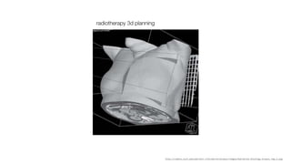 radiotherapy 3d planning




                           http://radonc.ucsf.edu/patient_information/breast/images/Radiation_Oncology_breast_img_2.jpg
 
