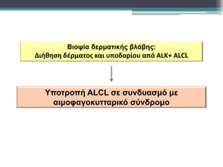 Υποτροπή ALCL σε συνδυασμό με
αιμοφαγοκυτταρικό σύνδρομο
Βιοψία δερματικής βλάβης:
Διήθηση δέρματος και υποδορίου από ALK+ ALCL
 