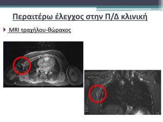  MRI τραχήλου-θώρακος
Περαιτέρω έλεγχος στην Π/Δ κλινική
 
