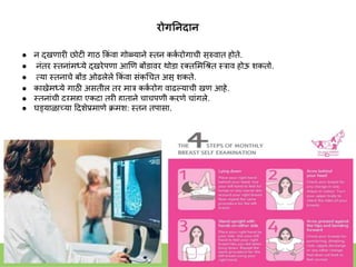 रोगननदान
● ि दुखणारी छोटी गाठ ककां वा गोळयािे स्त्ति कक
क रोगाची सुरुवात होते.
● िांतर स्त्तिाांमध्ये दुखरेपणा आणण बोंडावर थोडा रक्तशमगश्त स्त्राव होऊ िकतो.
● तया स्त्तिाचे बोंड ओढलेले ककां वा सांक
ु गचत असू िकते.
● काखेमध्ये गाठी असतील तर मार कक
क रोग वाढल्याची खूण आहे.
● स्त्तिाांची दरमहा एकदा तरी हातािे चाचपणी करणे चाांगले.
● घड्याळाच्या हदिेप्रमाणे क्रमि: स्त्ति तपासा.
 