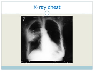 X-ray chest 