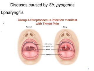 Diseases caused by Str. pyogenes
I.pharyngitis
.
.
6
 