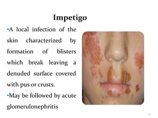 •A local infection of the
skin characterized by
formation of blisters
which break leaving a
denuded surface covered
with pus or crusts.
•May be followed by acute
glomerulonephritis
Impetigo
7
 