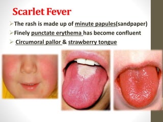 Sandpaper Rashes Streptococcal infections | PPSX