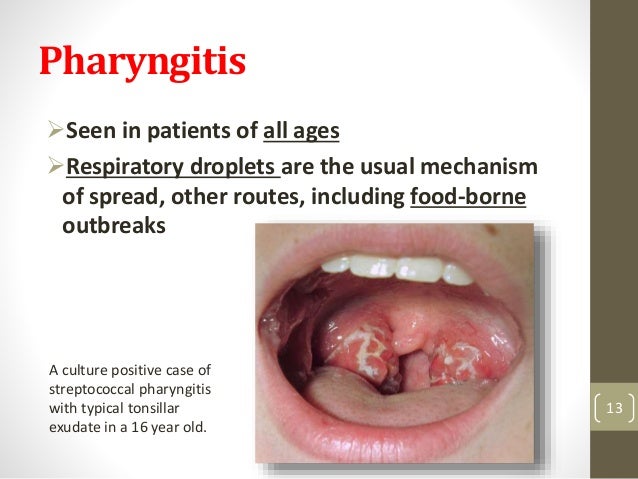 Streptococcal Infections