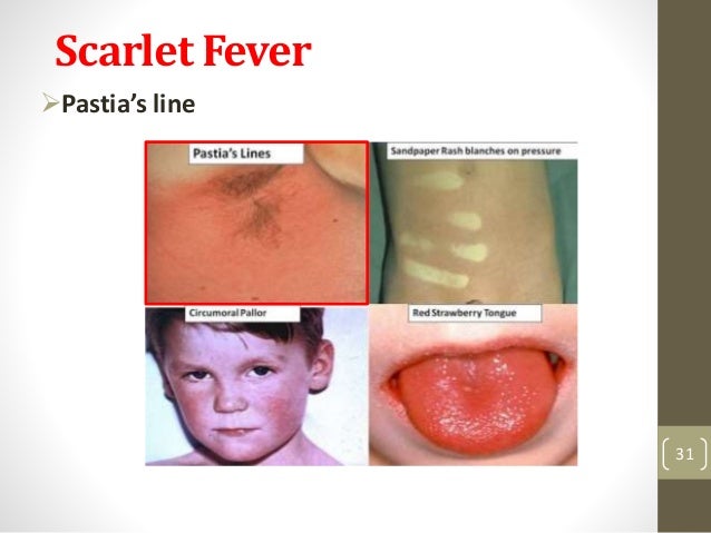Streptococcal infections