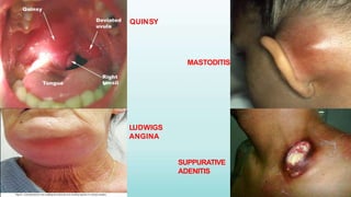 08-07-2015 23
QUINSY
MASTODITIS
LUDWIGS
ANGINA
SUPPURATIVE
ADENITIS
 