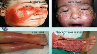 ERYSIPELAS IMPETIGO
CELLULITIS NECROTISING FASCIITIS
 