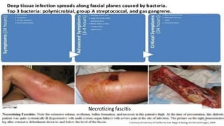 Necrotizing fascitis
31
 