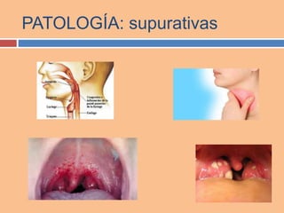 PATOLOGÍA: supurativas
 