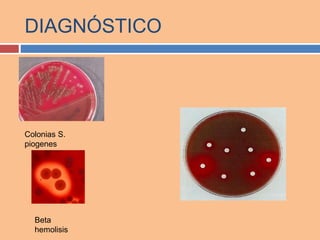 Colonias S.
piogenes
Beta
hemolisis
DIAGNÓSTICO
 