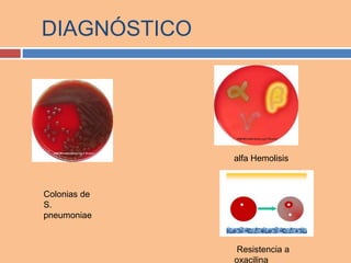 DIAGNÓSTICO
Resistencia a
oxacilina
alfa Hemolisis
Colonias de
S.
pneumoniae
 