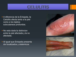  A diferencia de la Erisipela, la
Celulitis afecta tanto a la piel
como a los tejidos
subcutaneos profundos.
 No esta dada la distincion
entre la piel afectada y la no
afectada.
 Al igual que Erisipela presenta
stx localizados y sistemicos
 