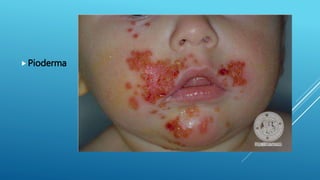 Strept Pyoderma Streptococcus | PPTX