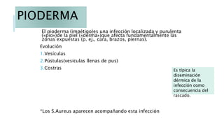 PIODERMA
El pioderma (impétigo)es una infección localizada y purulenta
(«pio»)de la piel («derma»)que afecta fundamentalmente las
zonas expuestas (p. ej., cara, brazos, piernas).
Evolución
1.Vesículas
2.Pústulas(vesiculas llenas de pus)
3.Costras
*Los S.Aureus aparecen acompañando esta infección
Es típica la
diseminación
dérmica de la
infección como
consecuencia del
rascado.
 