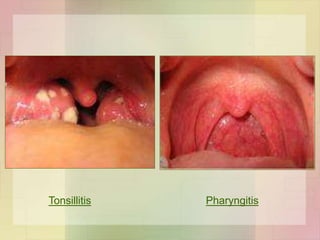 Tonsillitis Pharyngitis
 