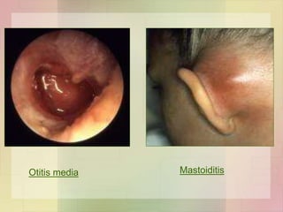Otitis media Mastoiditis
 