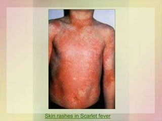 Skin rashes in Scarlet fever
 