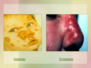 Impetigo Erysipelas
 