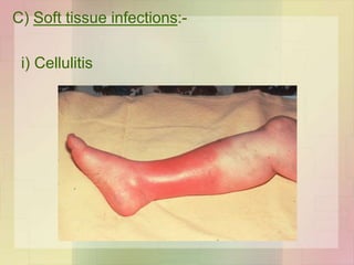 C) Soft tissue infections:-
i) Cellulitis
 
