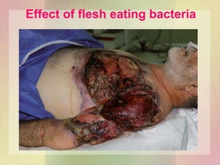 Effect of flesh eating bacteria
 