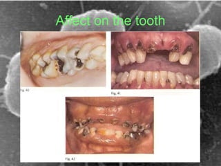 Affect on the tooth 