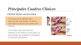 OTITITS MEDIA AGUDA (OMA)
Principales Cuadros Clínicos
Consiste en la inflamación e
infección del oído medio, el cual se
encuentra localizado justo detrás del
tímpano
 Las infecciones del oído son
comunes en los bebés y en los niños, en
parte porque sus trompas de Eustaquio
se obstruyen fácilmente
 