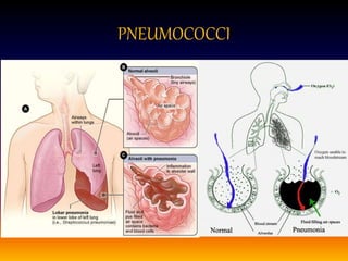 PNEUMOCOCCI
 