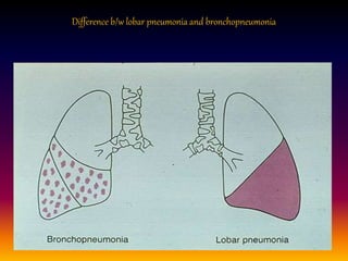 Difference b/w lobar pneumonia and bronchopneumonia
 