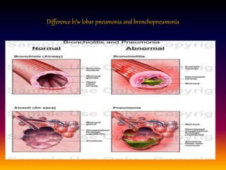 Difference b/w lobar pneumonia and bronchopneumonia
 