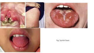 Fig: Scarlet fever.
 