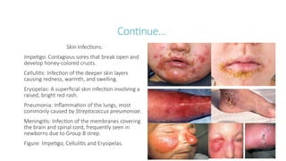 Continue…
Skin Infections:
Impetigo: Contagious sores that break open and
develop honey-colored crusts.
Cellulitis: Infection of the deeper skin layers
causing redness, warmth, and swelling.
Erysipelas: A superficial skin infection involving a
raised, bright red rash.
Pneumonia: Inflammation of the lungs, most
commonly caused by Streptococcus pneumoniae.
Meningitis: Infection of the membranes covering
the brain and spinal cord, frequently seen in
newborns due to Group B strep.
Figure: Impetigo, Cellulitis and Erysipelas.
 