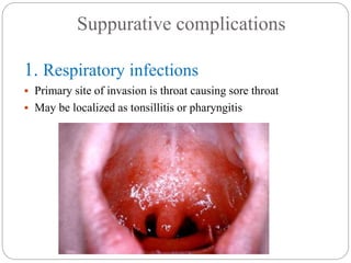 Suppurative complications
1. Respiratory infections
 Primary site of invasion is throat causing sore throat
 May be localized as tonsillitis or pharyngitis
 