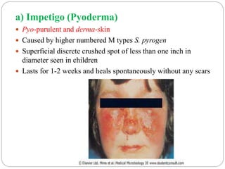 a) Impetigo (Pyoderma)
 Pyo-purulent and derma-skin
 Caused by higher numbered M types S. pyrogen
 Superficial discrete crushed spot of less than one inch in
diameter seen in children
 Lasts for 1-2 weeks and heals spontaneously without any scars
 