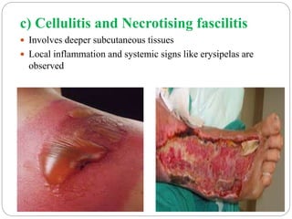 c) Cellulitis and Necrotising fascilitis
 Involves deeper subcutaneous tissues
 Local inflammation and systemic signs like erysipelas are
observed
 