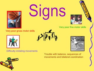 Very poor fine motor skills
Very poor gross motor skills
Difficulty imitating movements
Trouble with balance, sequences of
movements and bilateral coordination
 